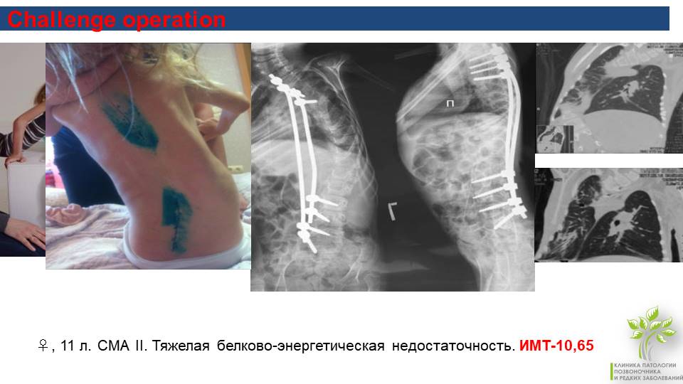 Сма это. Операция на позвоночнике при СМА. При спинальной амиотрофии наблюдаются. Хирургическое лечение при СМА до и после.