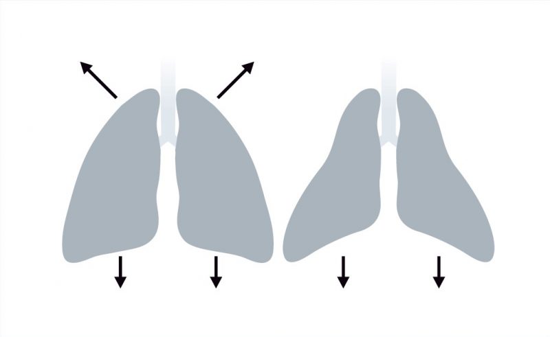 Рис. 1. Слева – форма грудной клетки здорового человека. Справа – килевидная деформация грудной клетки при СМА.
